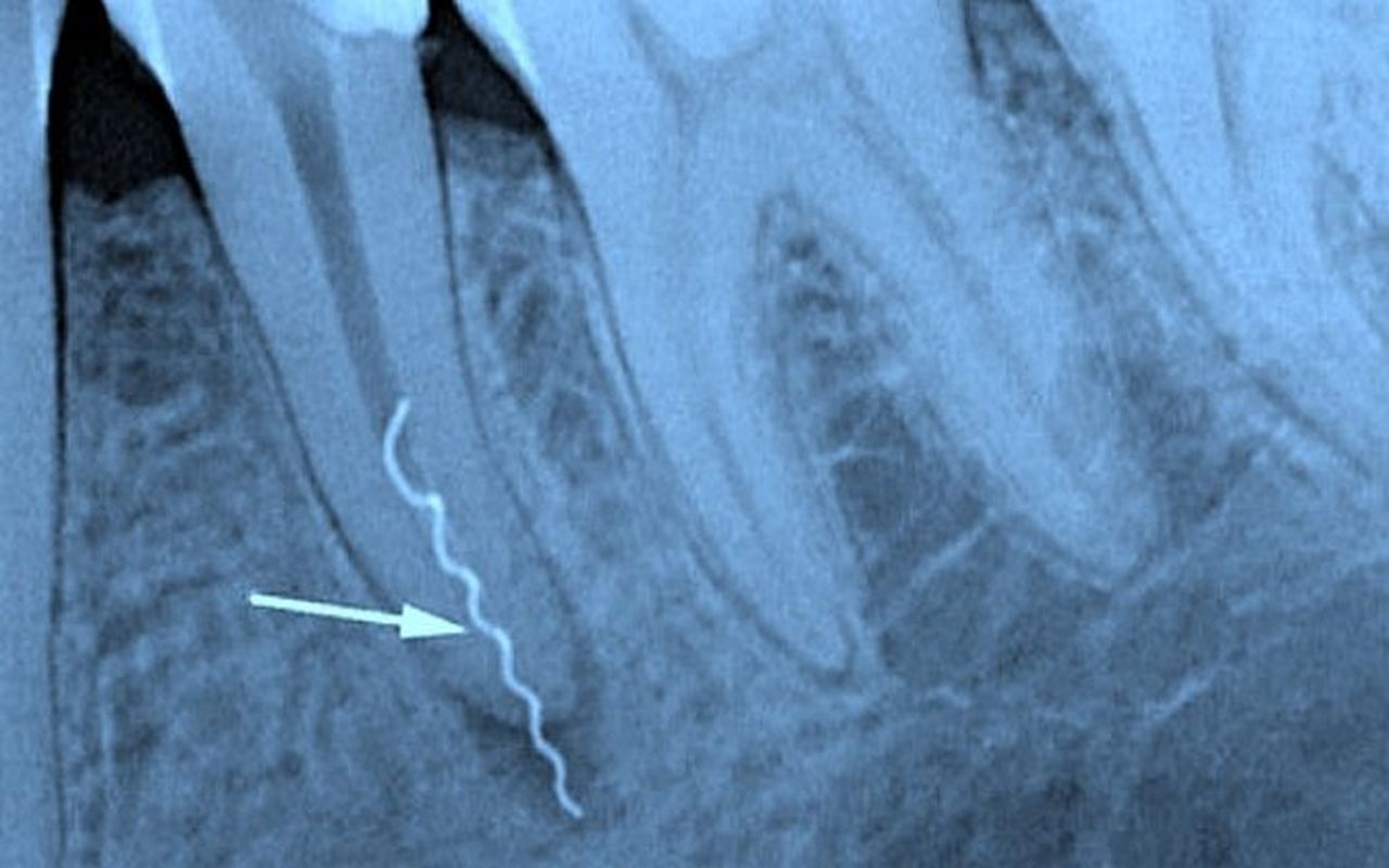 пульсирующая боль в зубе после удаления нерва