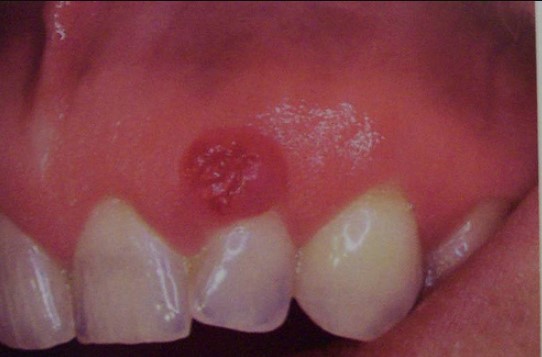 гранулема зуба фото 1