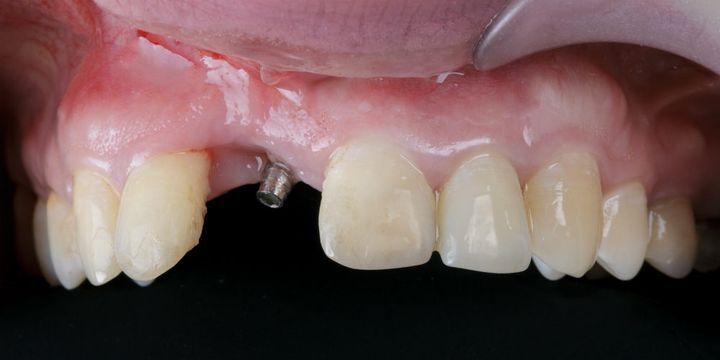 удаленный передний зуб