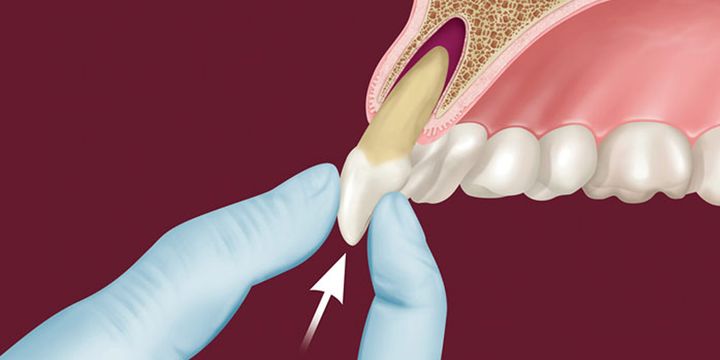 процесс удаления переднего зуба