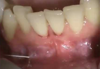 Фото 1. Цистэктомия зуба