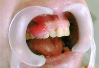 Фото 3. Цистэктомия зуба