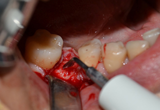 Фото 4. Цистэктомия зуба