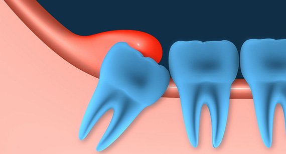 Иссечение воспаленной слизистой над зубом