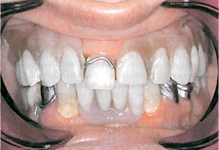 Фото 5. Съемные зубные протезы