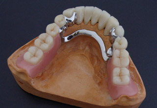 Фото 6. Съемные зубные протезы
