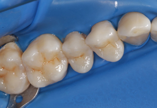 Фото 9. Восстановление жевательных зубов