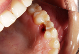 Фото 2. Восстановление жевательных зубов