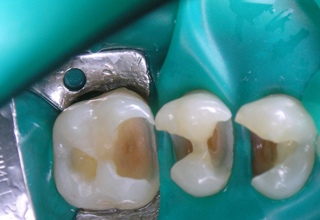 Фото 5. Восстановление жевательных зубов