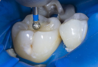 Фото 6. Восстановление жевательных зубов