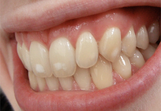 белое пятно на зубе фото