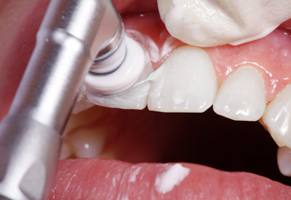 Профессиональная гигиена полости рта в стоматологии Москвы