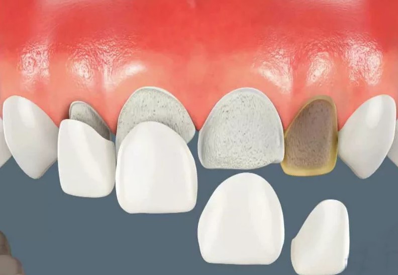 реставрация передних зубов в стоматологии Москвы