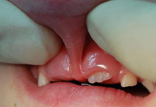 Фото 4. Пластика уздечки губы