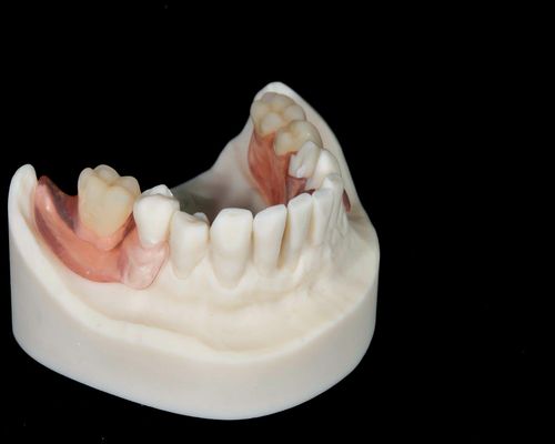 Иммедиат протез на месте жевательных зубов