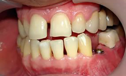 Имплантация зубов. Фото 2