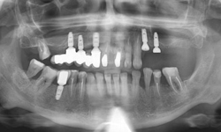 Имплантация зубов. Фото 5
