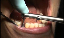 Имплантация зубов. Фото 9