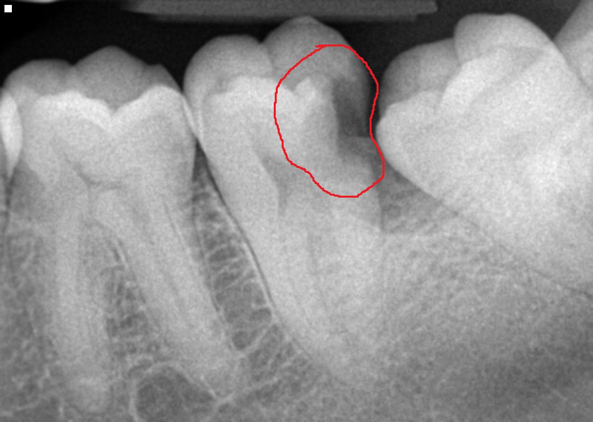 Скол зуба ниже уровня десны