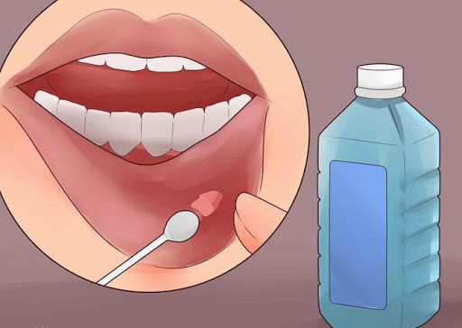 Причины ретенционной кисты нижней губы