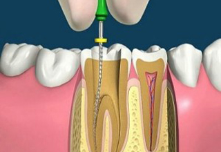 Фото 2. Удаление нерва зуба