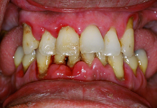 Фото 1. Воспаление слизистой оболочки полости рта