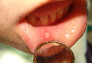 Фото 3. Воспаление слизистой оболочки полости рта