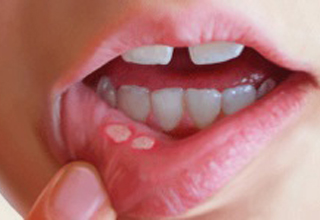 Фото 4. Воспаление слизистой оболочки полости рта