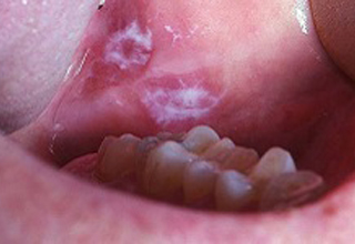 Фото 5. Воспаление слизистой оболочки полости рта