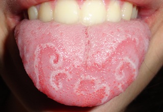 Фото 6. Воспаление слизистой оболочки полости рта