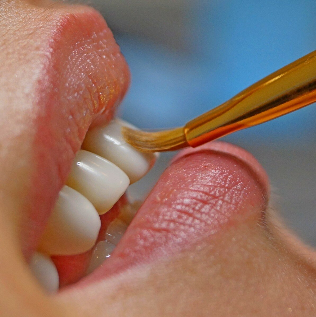 восстановление зубной эмали в стоматологии 