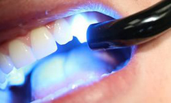 процедура лазерного отбеливания зубов: фото 2