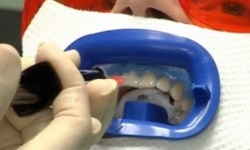 процедура ЗУМ отбеливания зубов: фото 2