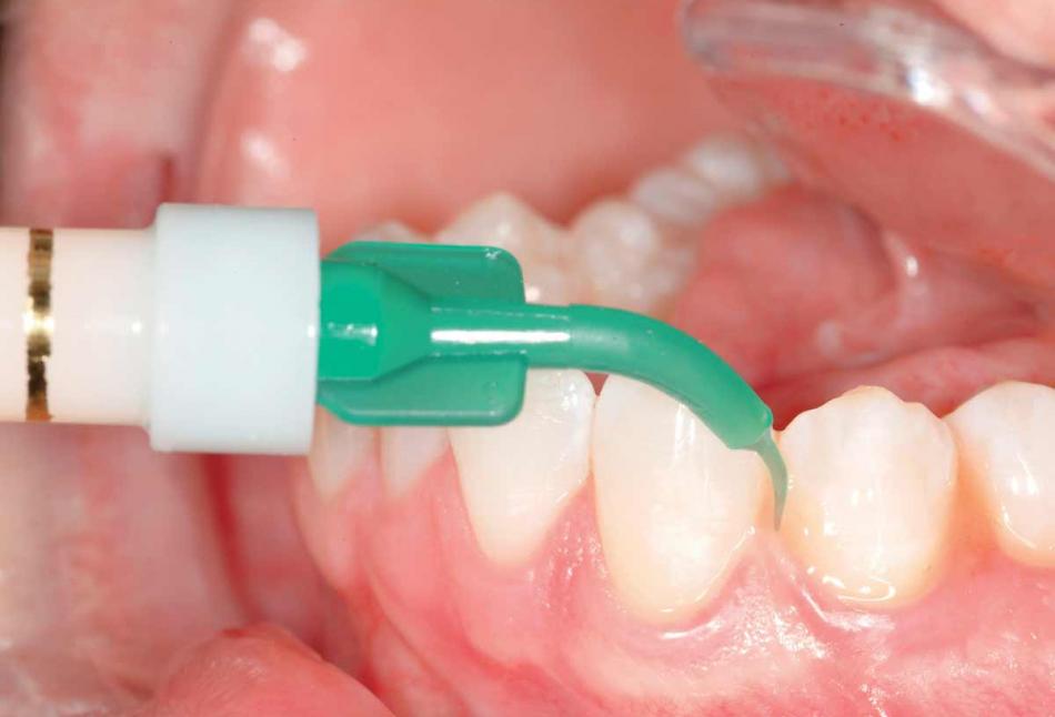 Аппликационная анестезия в стоматологии 
