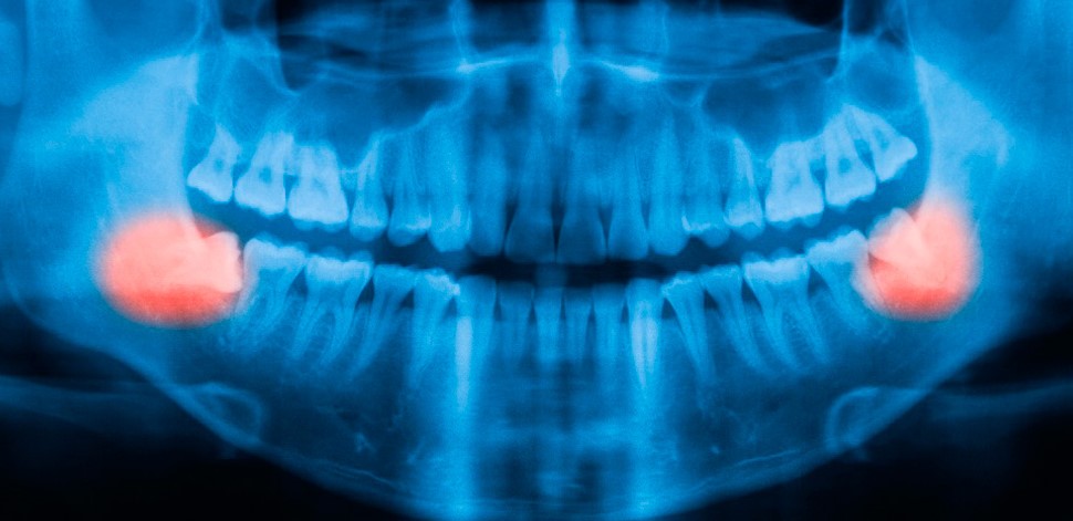зуб мудрости рентген фото