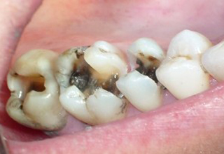 Пример 2. Кариес зубов