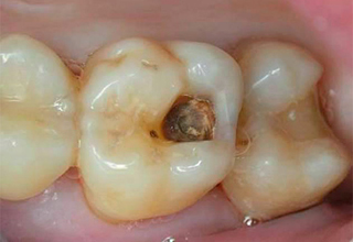Пример 3. Кариес зубов