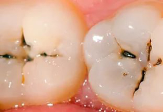 Пример 4. Кариес зубов
