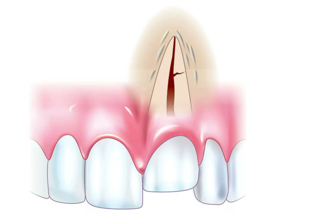 травма зуба на фото