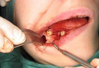 Фото 3. Резекция верхушки корня зуба
