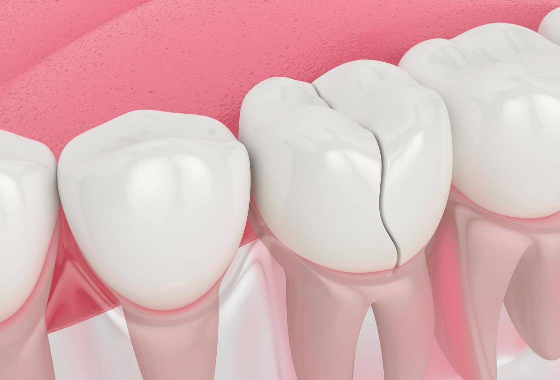 Что делать если треснул зуб и раскололся: первая помощь и лечение при появлении трещины на зубах