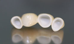 Фото 9. Зубные коронки