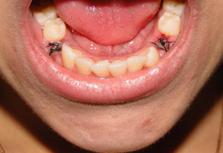 Фото 9. Сложное удаление зубов