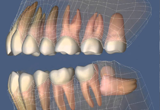 Фото 1. Ретинированные дистопированные зубы
