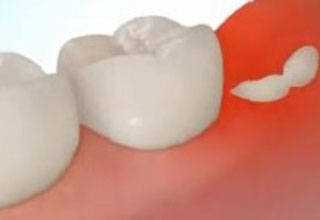 Фото 3. Ретинированные дистопированные зубы