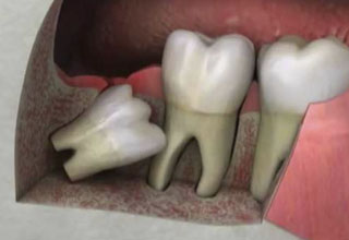 Фото 4. Ретинированные дистопированные зубы