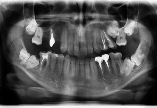 Фото 6. Ретинированные дистопированные зубы