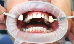 Фото 1. Лазерное отбеливание зубов