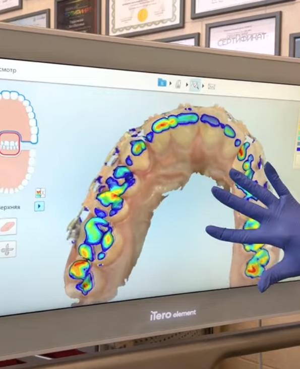 интраоральное сканирование зубов