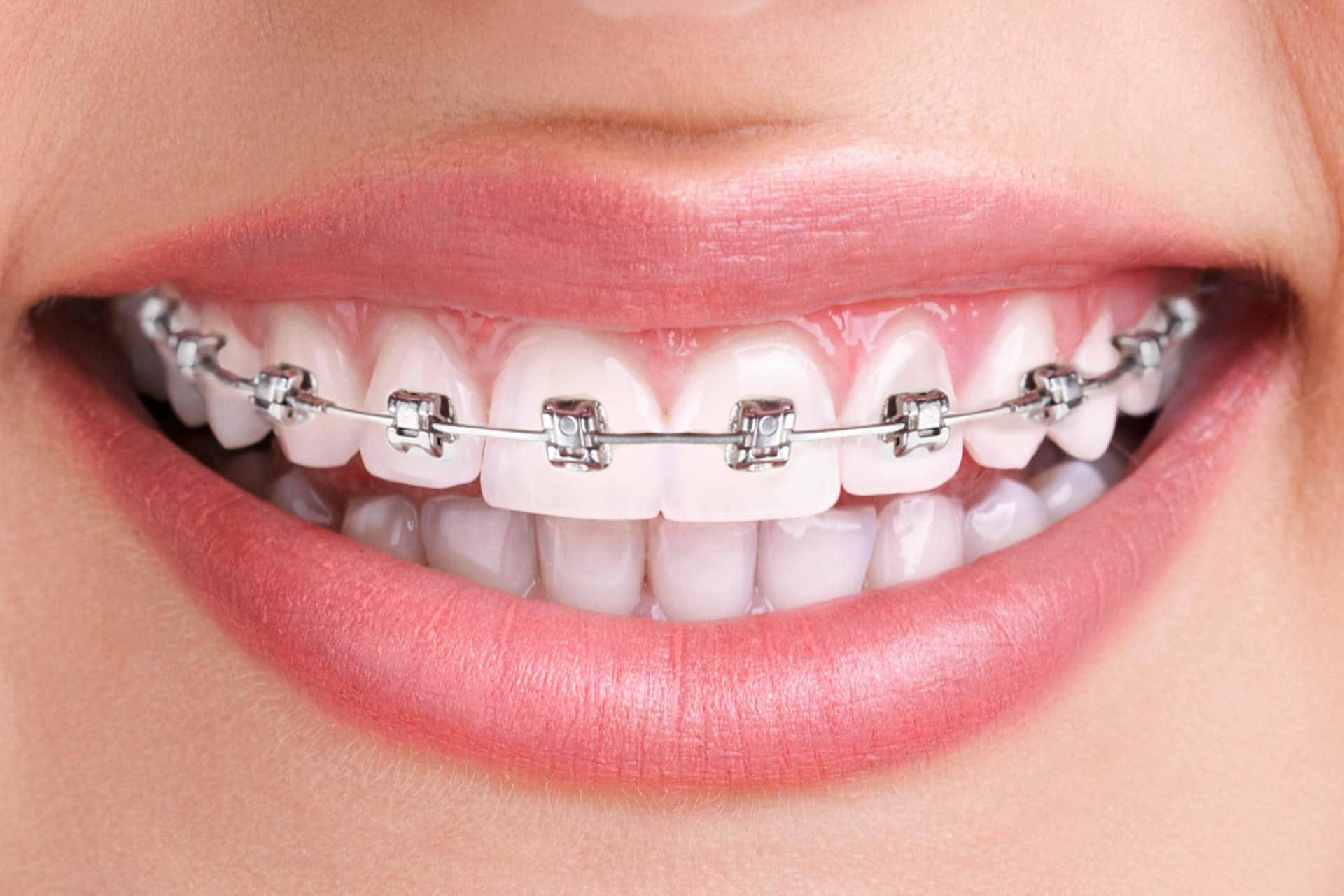 Металлические брекеты на верхние зубы